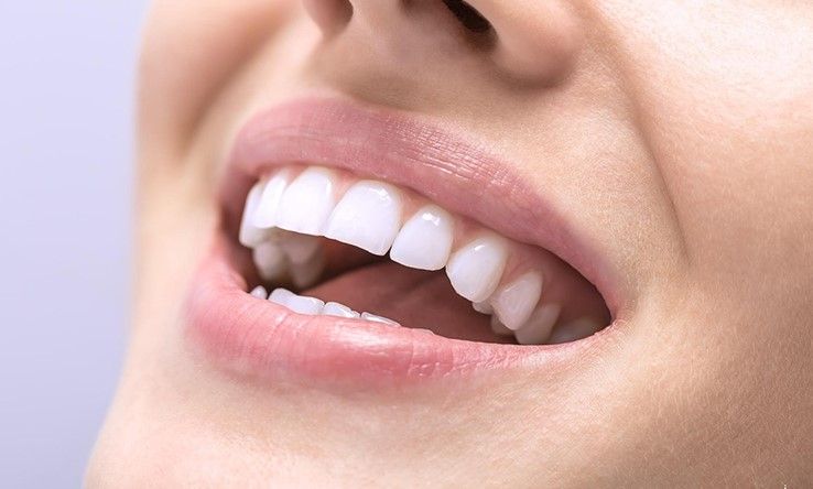 آفیس بلیچینگ (سفید کردن دندان) دو فک آمریکایی