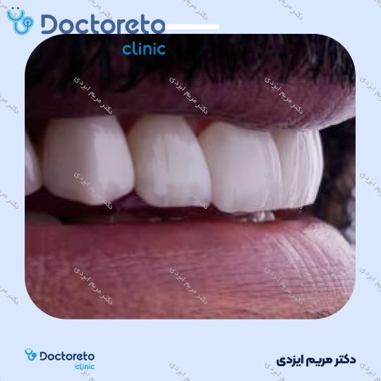 لمینت سرامیکی ایمکس آلمان (هر واحد)
