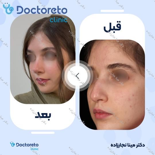 عمل زیبایی بینی (رینوپلاستی)