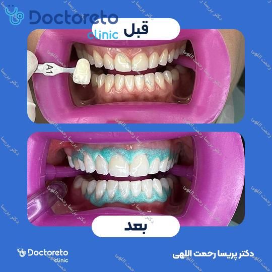 هوم بلیچینگ (سفید کردن دندان) دو فک با مواد آلمانی whitesmile