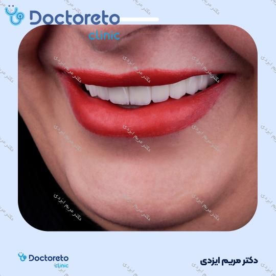 لمینت سرامیکی ایمکس آلمان (هر واحد)