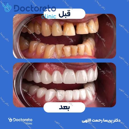 پکیج پالیش کامپوزیت و جرمگیری بروساژ دو فک