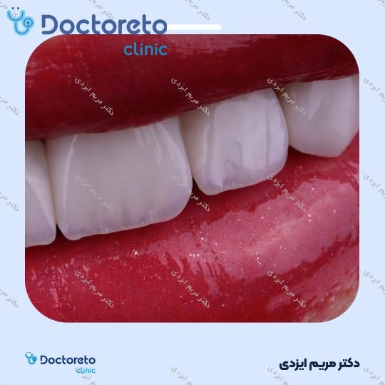 لمینت سرامیکی ایمکس آلمان (هر واحد)