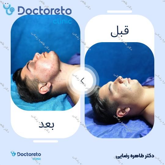 کاهش حجم غبغب با روش لیپو ساکشن