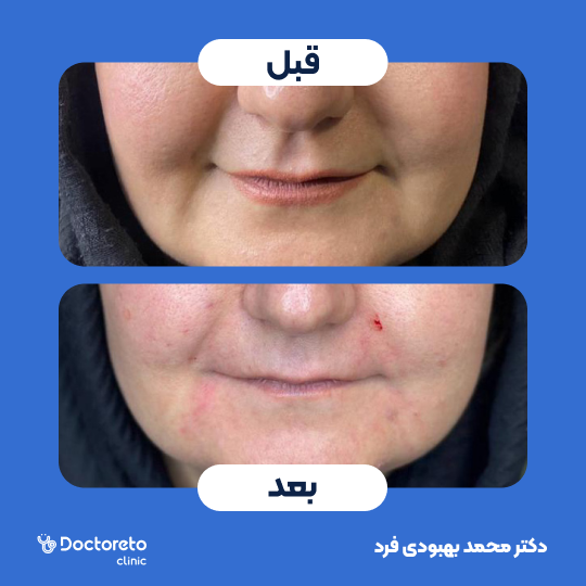تزریق ژل خط خنده با برند پرفکتا (1CC)
