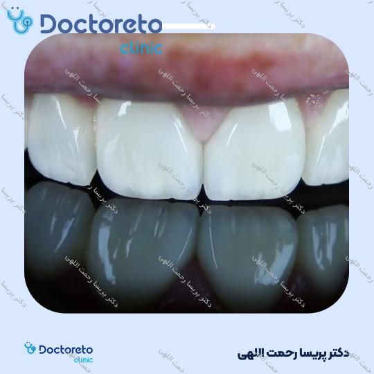 آفیس بلیچینگ (سفید کردن دندان) دو فک با مواد هلندی