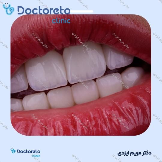 لمینت سرامیکی ایمکس آلمان (هر واحد)