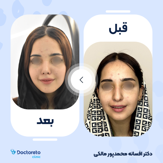 عمل جراحی مجدد زیبایی بینی (رینوپلاستی)