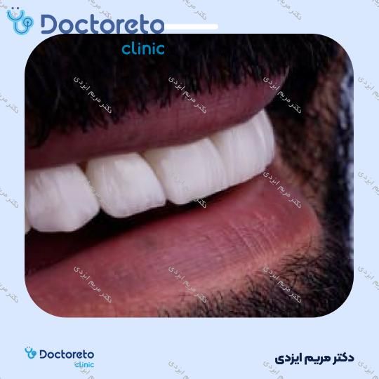 لمینت سرامیکی ایمکس آلمان (هر واحد)