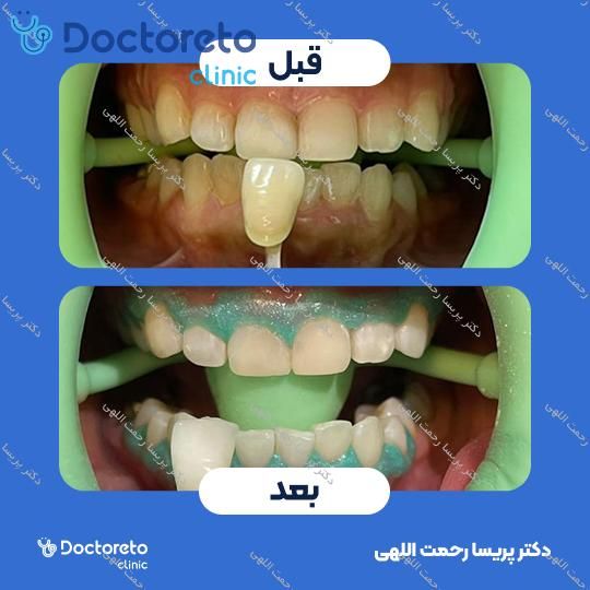 آفیس بلیچینگ (سفید کردن دندان) دو فک با مواد برزیلی fgm