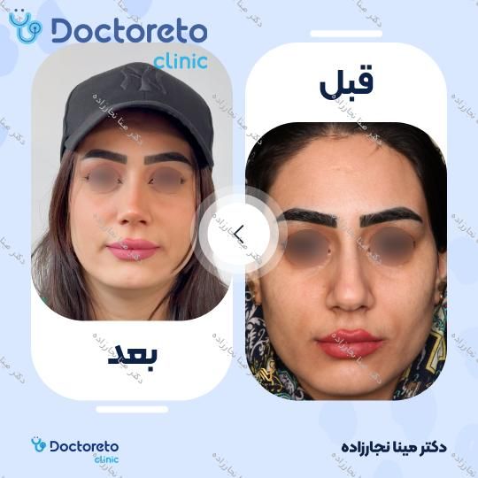 عمل زیبایی بینی (رینوپلاستی)