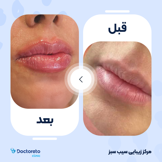 تزریق ژل لب با برند اینووسنس (1cc)