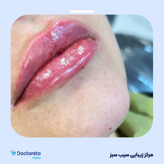 تزریق ژل لب با برند رووفیل (1cc)
