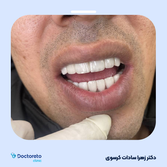 لمینت سرامیکی ایمکس آلمان (هر واحد)