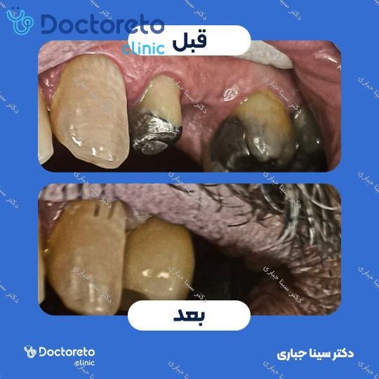 روکش استیل دندان S.S.CROWN (هر واحد)