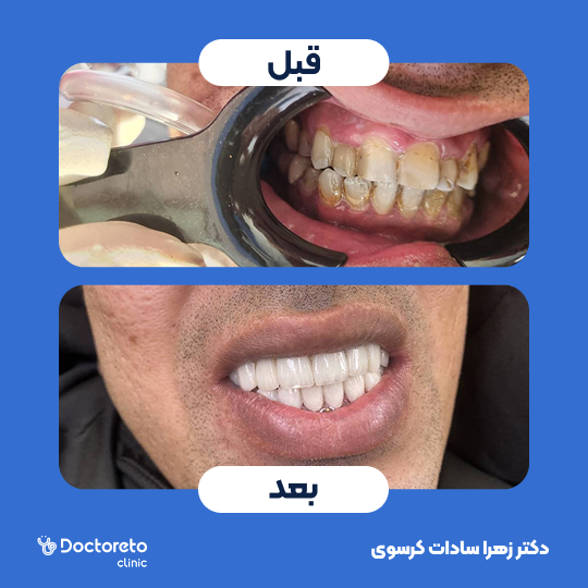 لمینت ایمکس vip (هر واحد)