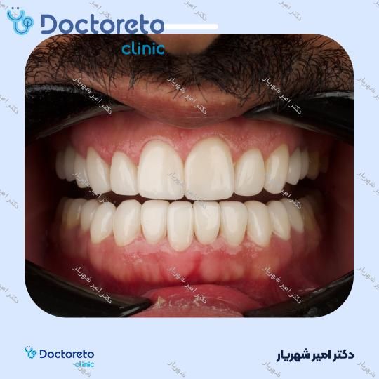ایمپلنت دنتیوم کره ای با روکش (هر واحد)