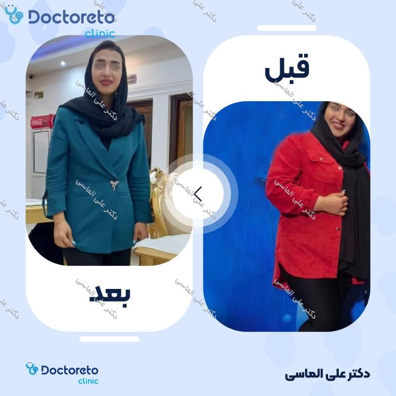 عمل جراحی ابدومینوپلاستی (جراحی زیبایی شکم )