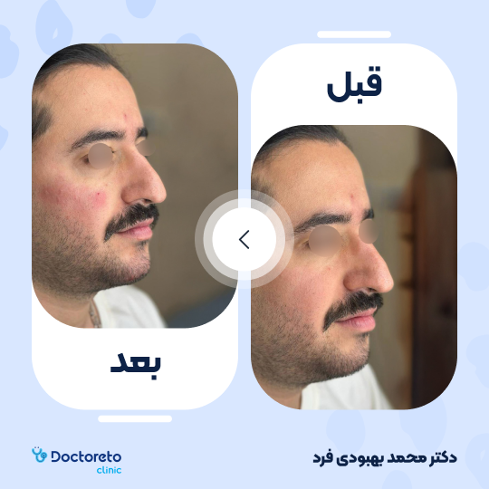 تزریق ژل چانه با برند نوکسیول (1cc)