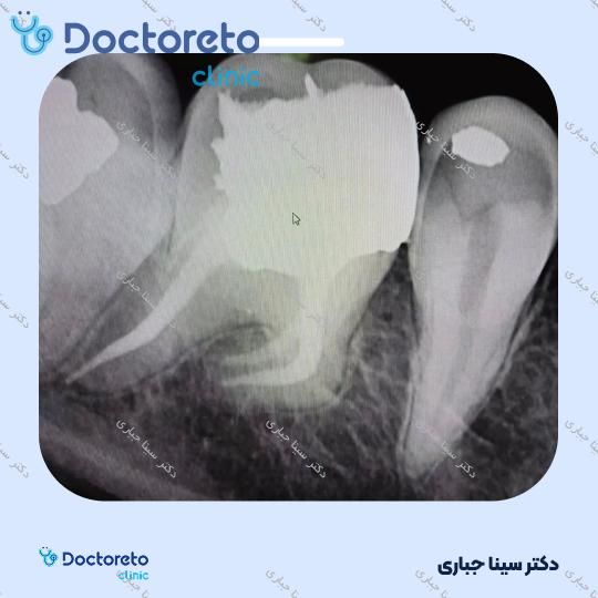 عصب کشی مجدد 3 کانال