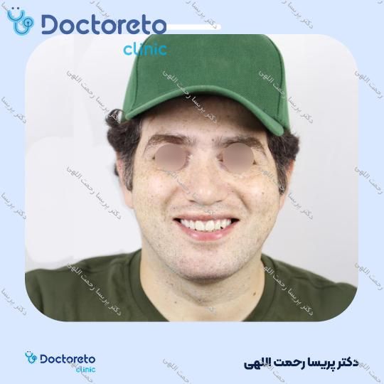 هوم بلیچینگ (سفید کردن دندان) دو فک با مواد آلمانی whitesmile