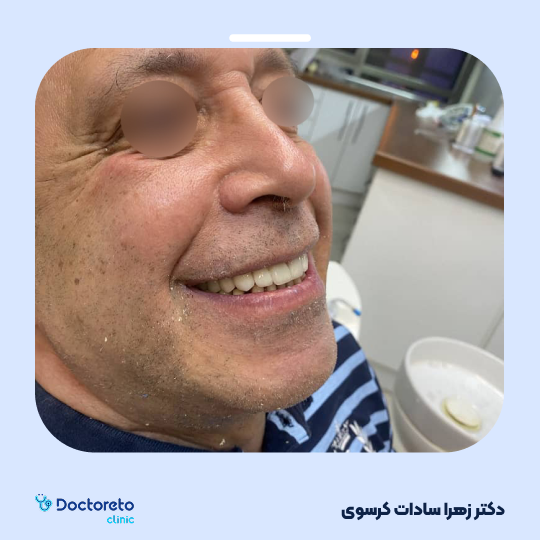 لمینت سرامیکی ایمکس آمریکا (هر واحد)