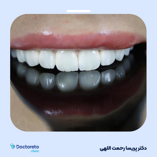 جرم گیری دو فک با بروساژ زیر لثه