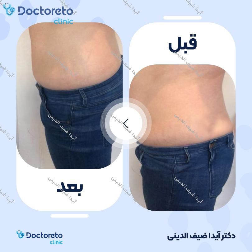 رفع سلولیت و افتادگی پوست (بانوان) با دستگاه RF