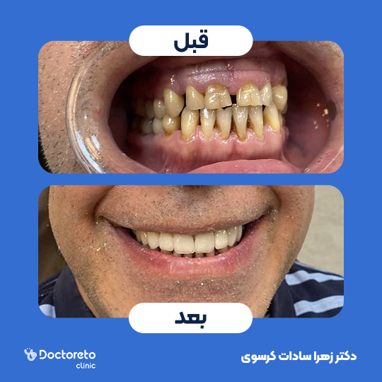 ونیر کامپوزیت توکویاما ژاپنی (هر واحد)