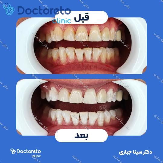 آفیس بلیچینگ (سفید کردن دندان) هر فک با Dentsply