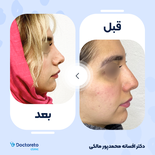 عمل زیبایی بینی (رینوپلاستی)