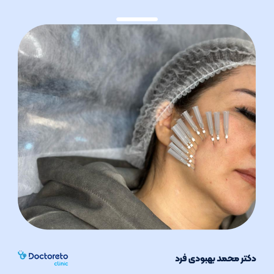 لیفت صورت با نخ جوانساز pcl screw برند dermavline (10 عدد)