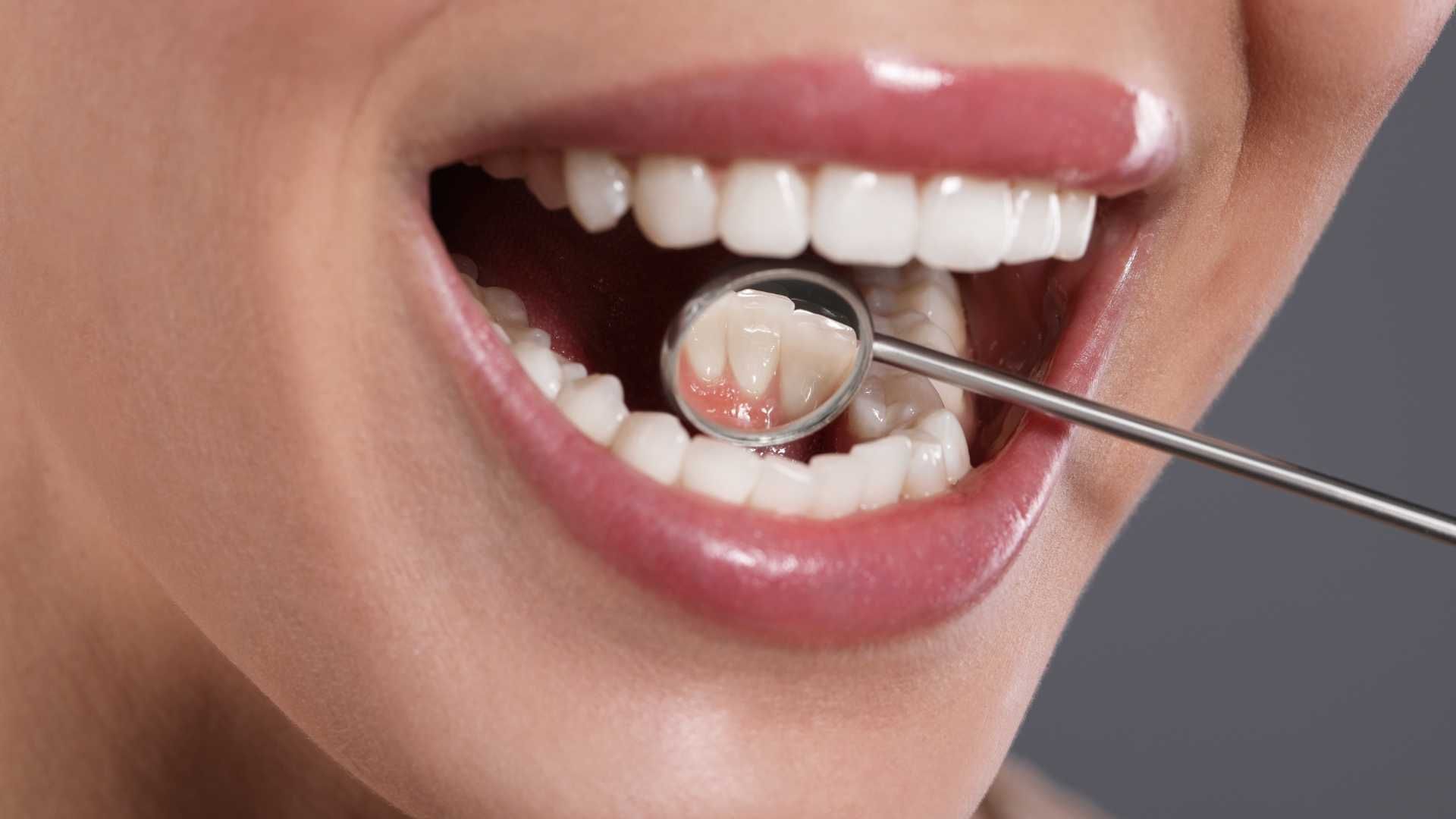 ونیر کامپوزیت استاتیکس دنسپلی X-White (هر واحد)