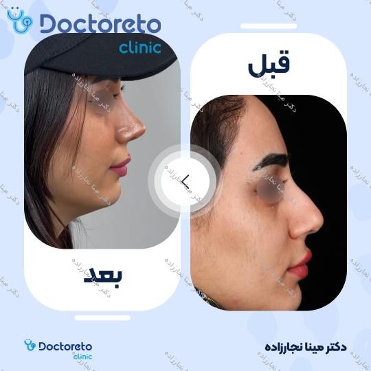 عمل زیبایی بینی (رینوپلاستی)