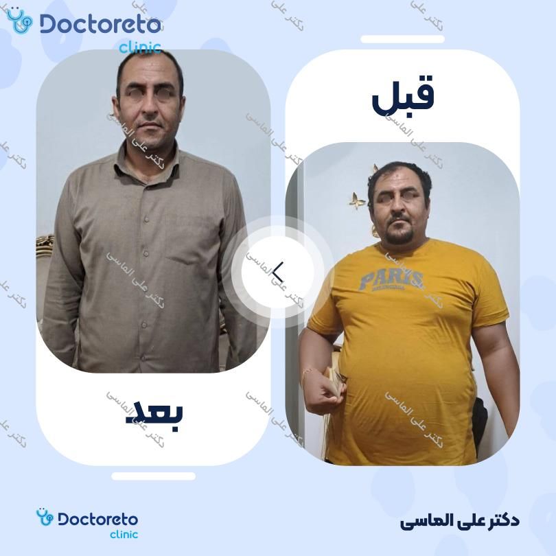 عمل جراحی پیکرتراشی
