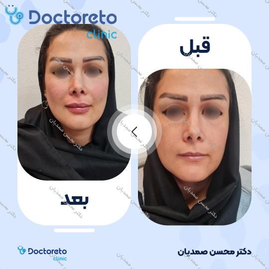تزریق ژل گونه با برند پرفکتا ساب اسکین (1cc)