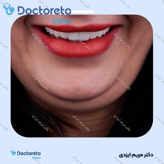 لمینت سرامیکی ایمکس آلمان (هر واحد)
