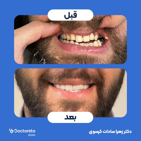 لمینت ایمکس vip (هر واحد)