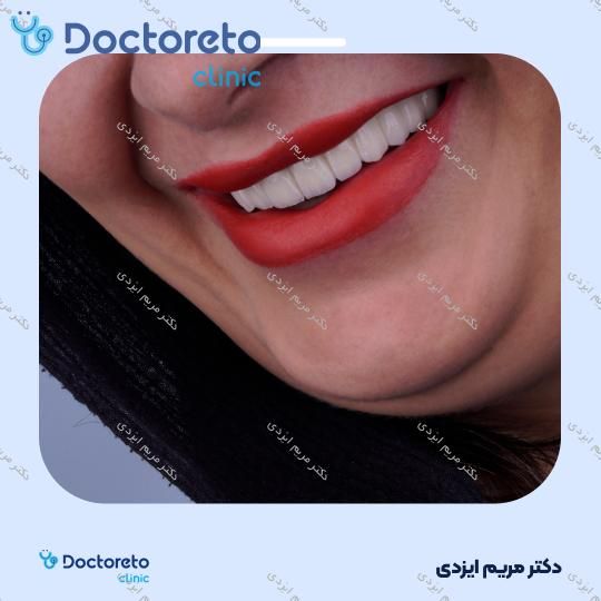 لمینت سرامیکی ایمکس آلمان (هر واحد)