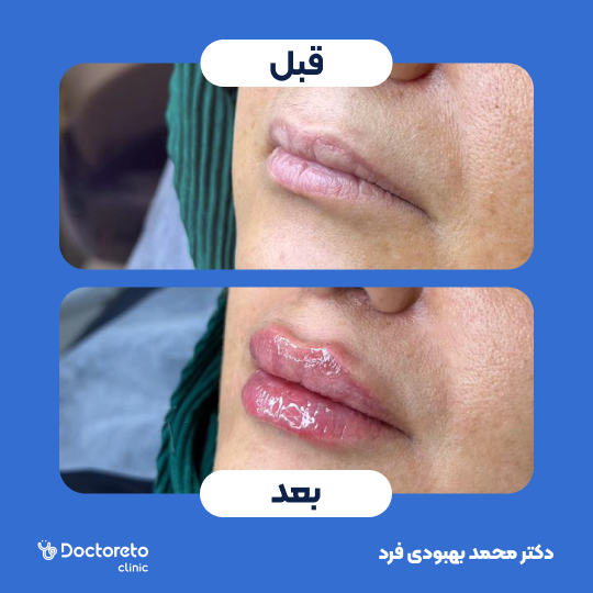 تزریق ژل لب با برند نوکسیول (1cc)