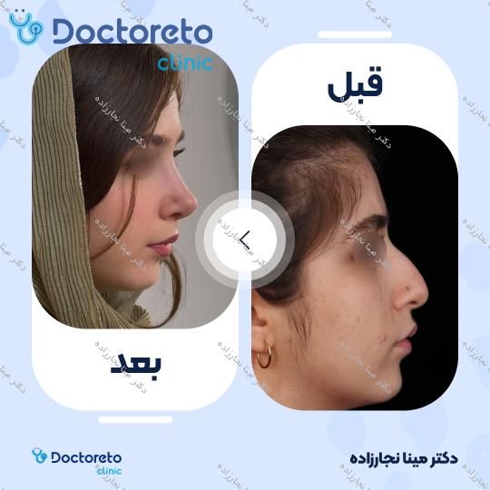 عمل زیبایی بینی (رینوپلاستی)