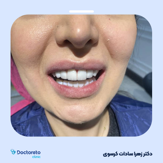 لمینت سرامیکی ایمکس آمریکا (هر واحد)