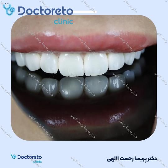 آفیس بلیچینگ (سفید کردن دندان) دو فک با مواد هلندی