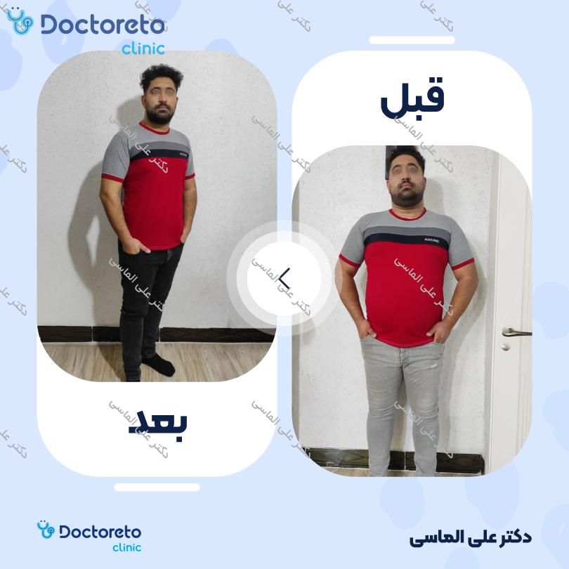 عمل جراحی ابدومینوپلاستی (جراحی زیبایی شکم )