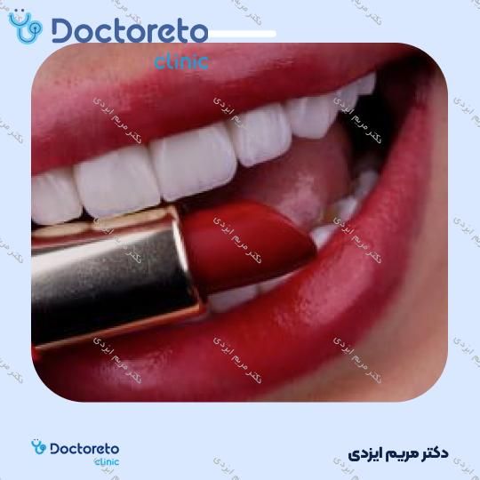 لمینت سرامیکی ایمکس آلمان (هر واحد)