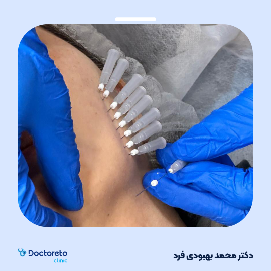 لیفت شقیقه با استفاده از نخ با برند درماویلاین (هر نخ)