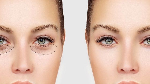 تزریق ژل زیر چشم با برند رمدیوم (1cc)