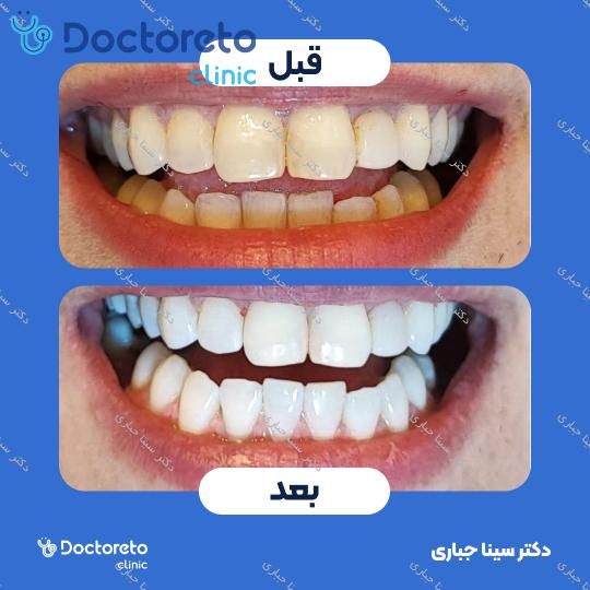 آفیس بلیچینگ (سفید کردن دندان) هر فک با مواد برزیلی fgm