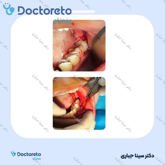 جراحی نسج سخت (هر دندان)