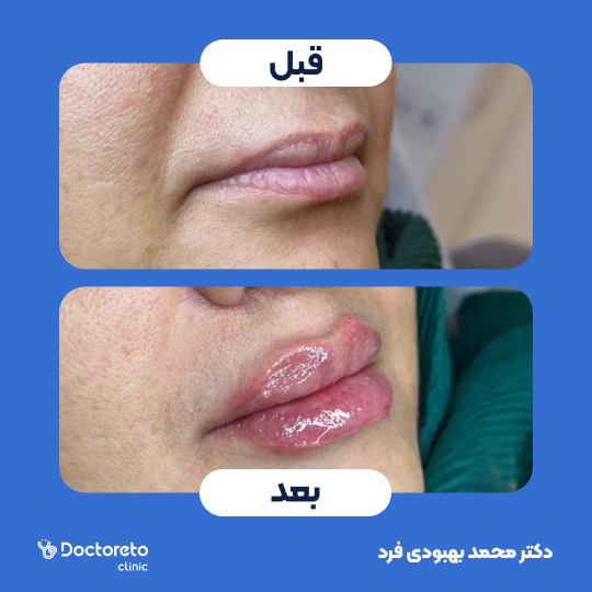 تزریق ژل لب با برند ریوانس Kiss+ (هر سی سی )